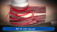 448khz Tecar Rehabilitation Machine Vacuum Cet Ret RF Monopolar Spa Clinic Physiotherapy