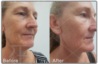 Face Lifting Anti Wrinkle SMAS Skin Tighten Machine