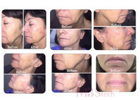 3d 11 Lines Anti Wrinkle Ultrasound Facelift HIFU Facial Machine